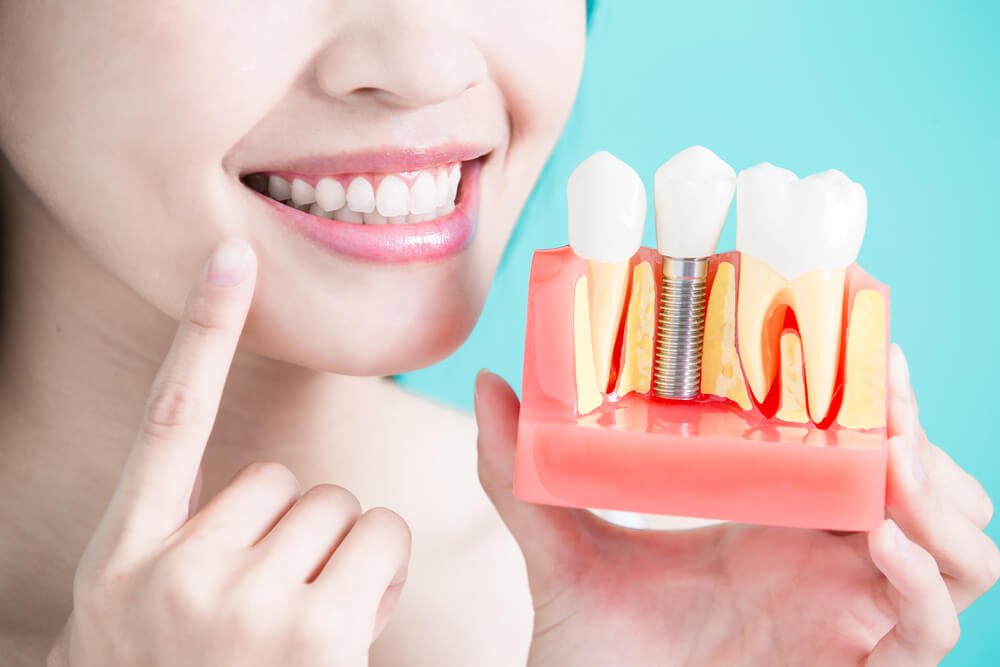 Dental Implants the Best Solution